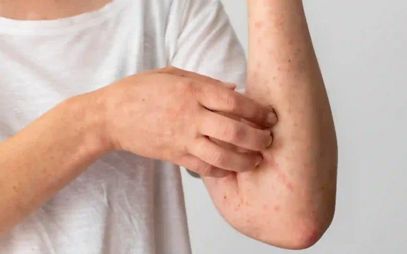 skin-allergy-reaction-person-s-arm